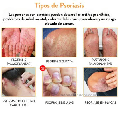 Psoriasis Treatment Sptray