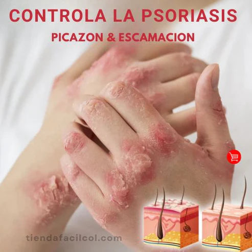 Psoriasis Treatment Sptray