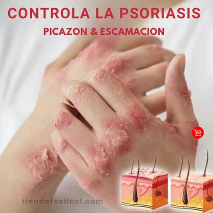 Psoriasis Treatment Sptray