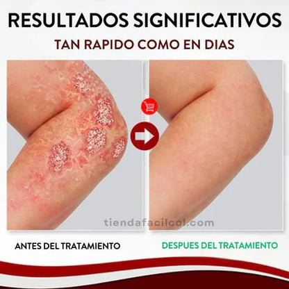 Psoriasis Treatment Sptray